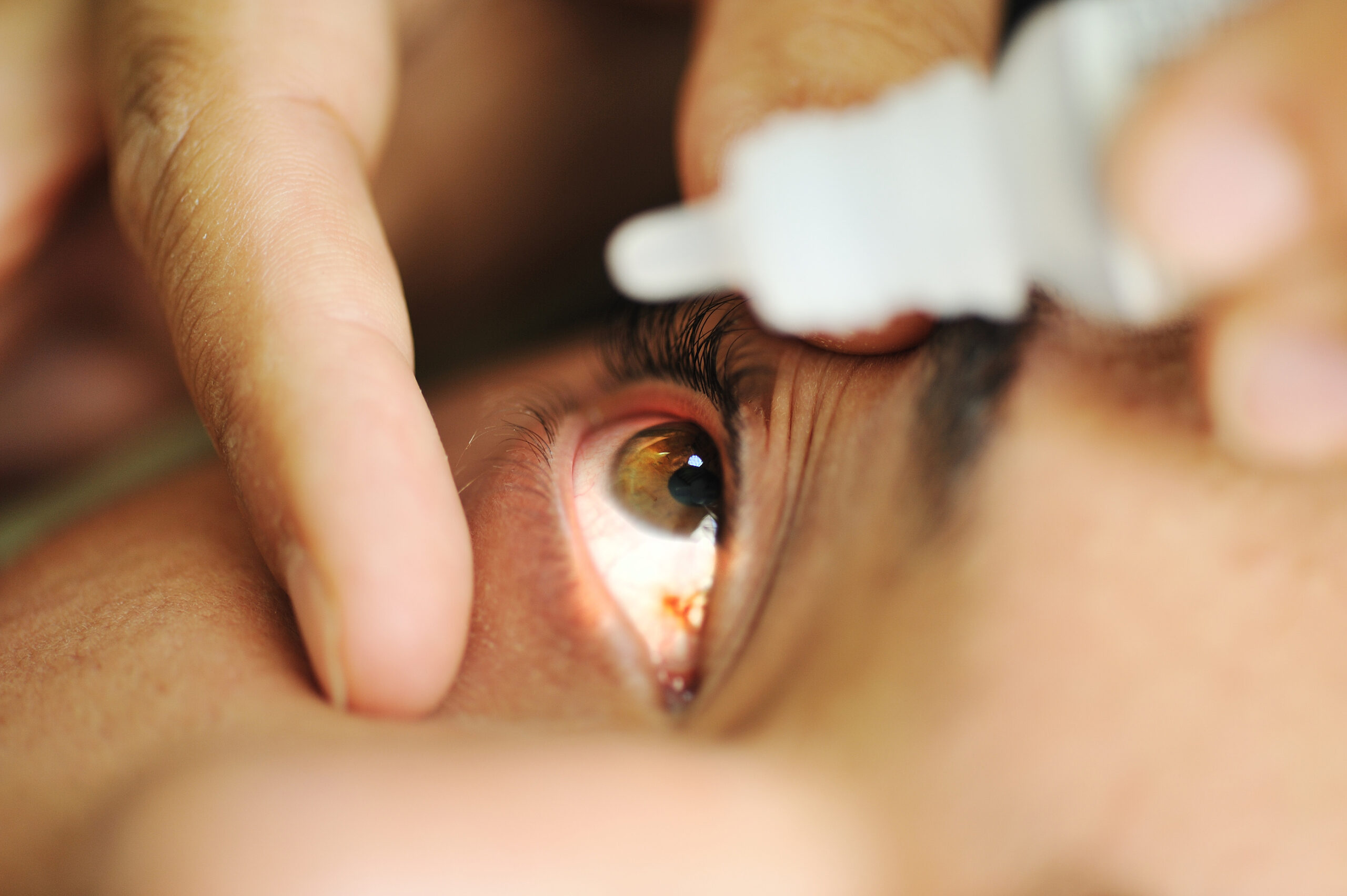 Death Toll Rises as Contaminated Eye Drops Cause Additional Antibiotic-Resistant Infections