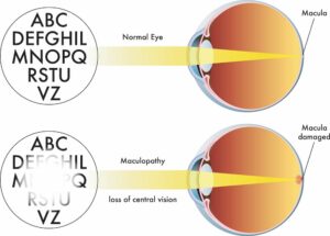Elmiron causing retinal maculopathy