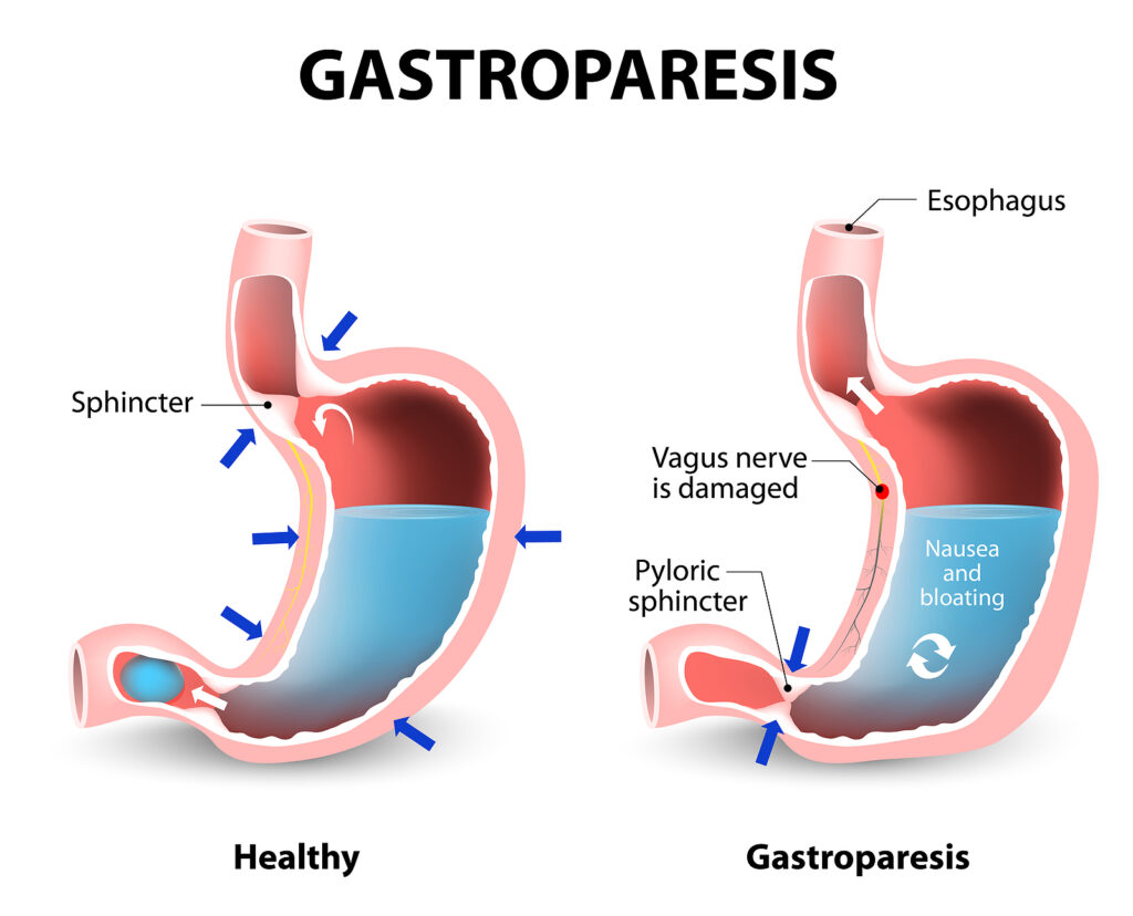 Gastroparesis diagram compared to a healthy stomach