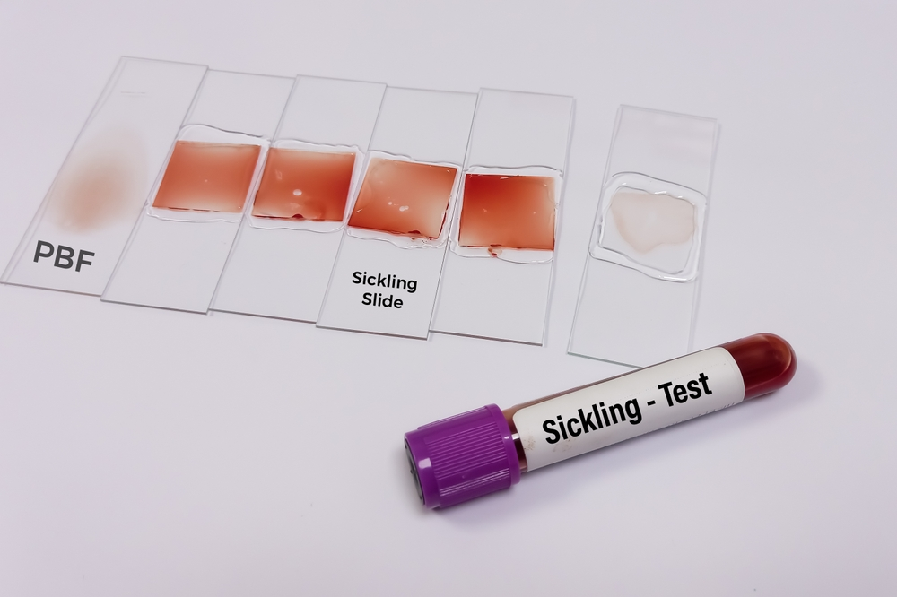Blood test for SCD Oxbryta