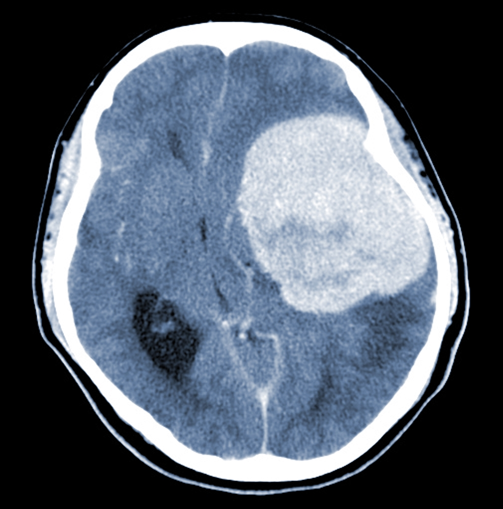 Ct scan of brain tumor - Depo Provera Lawsuit: Depo-Provera Lawsuits - Lawsuit Legal News