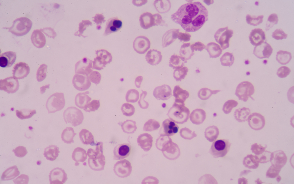 Irregular sickle blood cells from SCD after taking Oxbryta