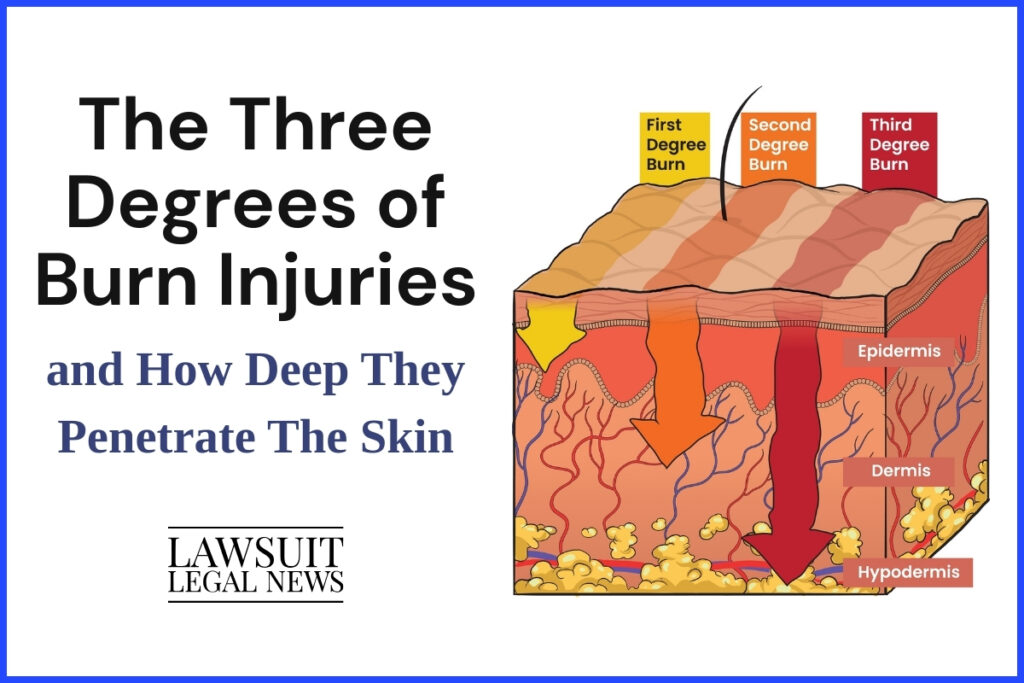 the three degree of burns graphic by LLN