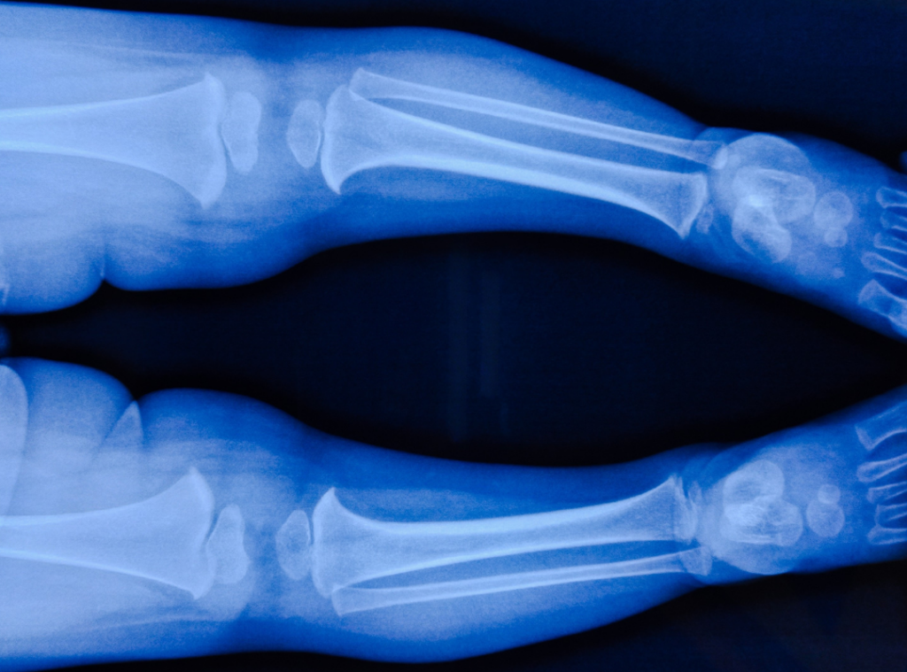 A pediatric skeletal X-ray illustrating the rickets and spontaneous bone fractures that led to Neocate lawsuits following a 2017 Yale study on hypophosphatemia.